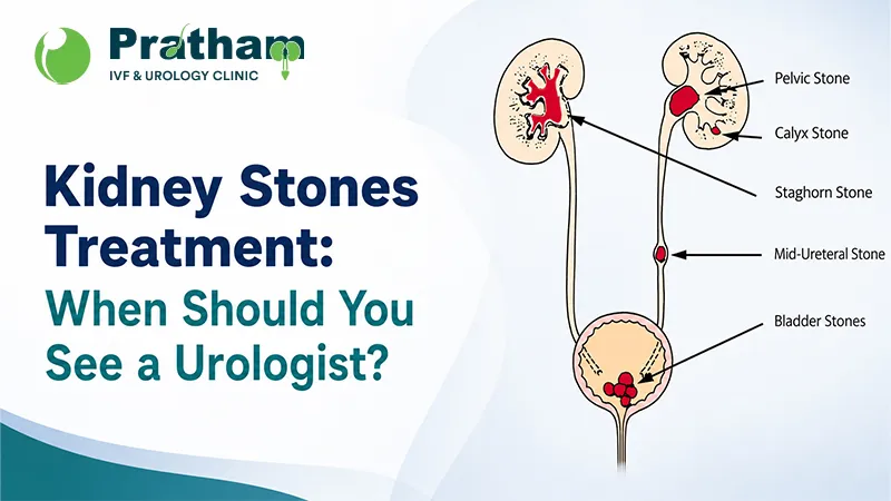 Kidney Stones Treatment: When Should You See a Urologist?