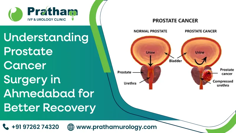 Understanding Prostate Cancer Surgery in Ahmedabad for Better Recovery